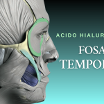 Curso de aplicación de Ácido Hialurónico Fosa Temporal