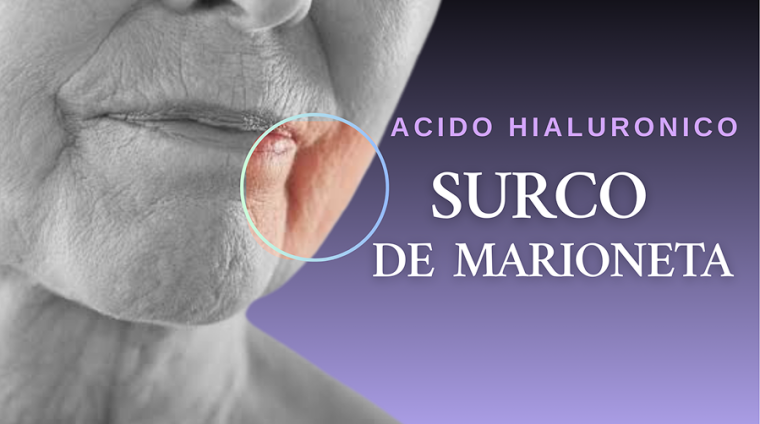 Curso acido hialuronico surco de marioneta